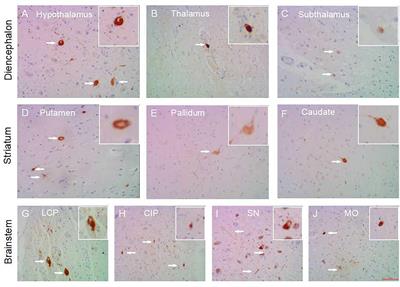 Primary Age-Related Tauopathy in Human Subcortical Nuclei